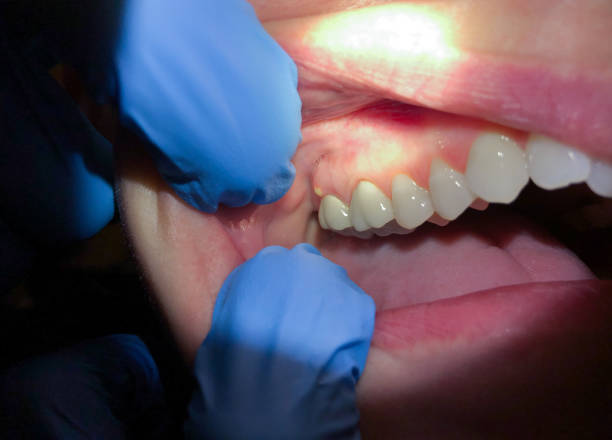 Best Emergency Broken Tooth Repair in La Plata, MD